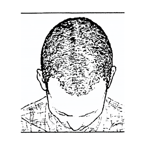 Reference drawing — top view of a man's head for hair-transplant photos