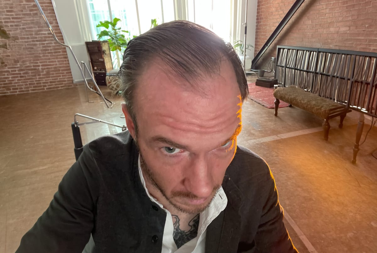 Allen before hair transplant (unedited)