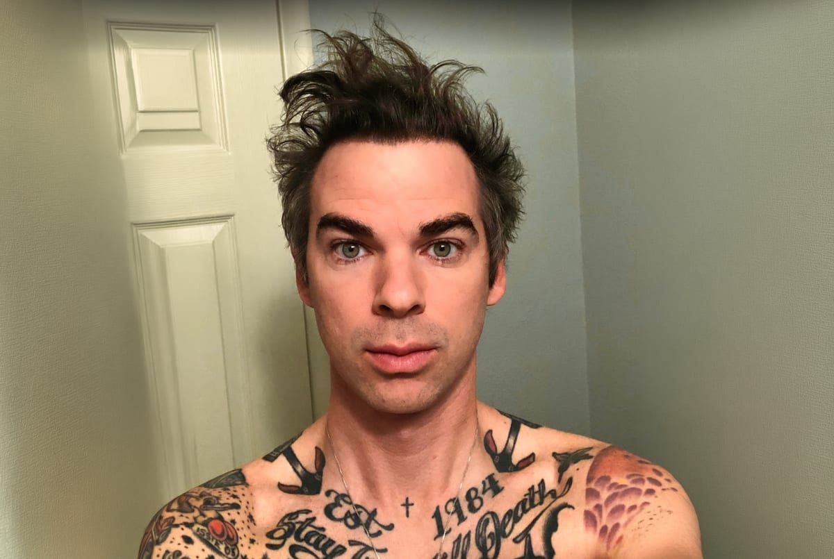 Benji after hair transplant (unedited)