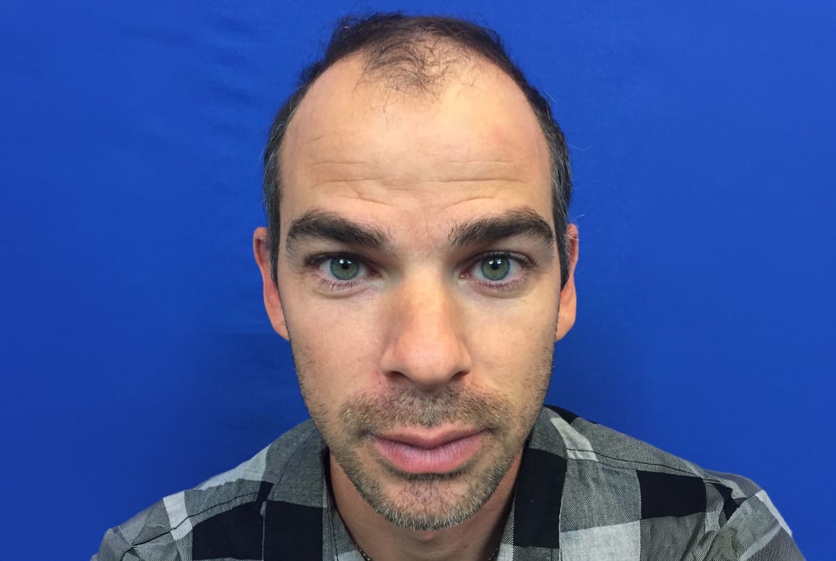 Benji before hair transplant (unedited)
