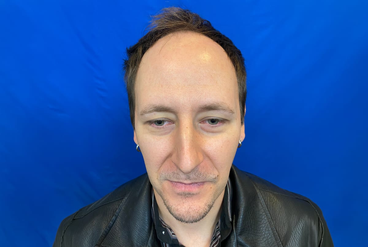 Daniel before hair transplant (unedited)