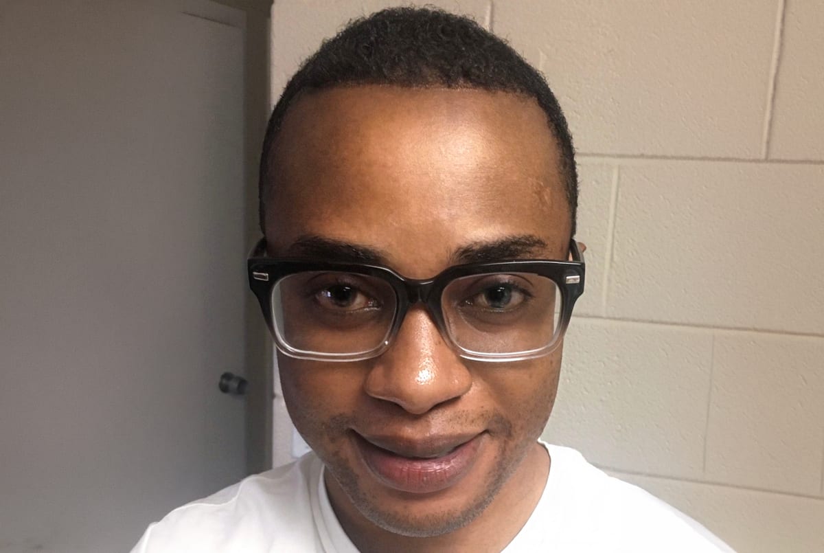 Davis after hair transplant (unedited)