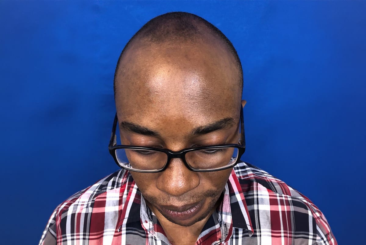 Davis before hair transplant (unedited)
