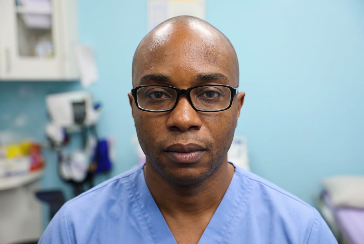 Davis before hair transplant