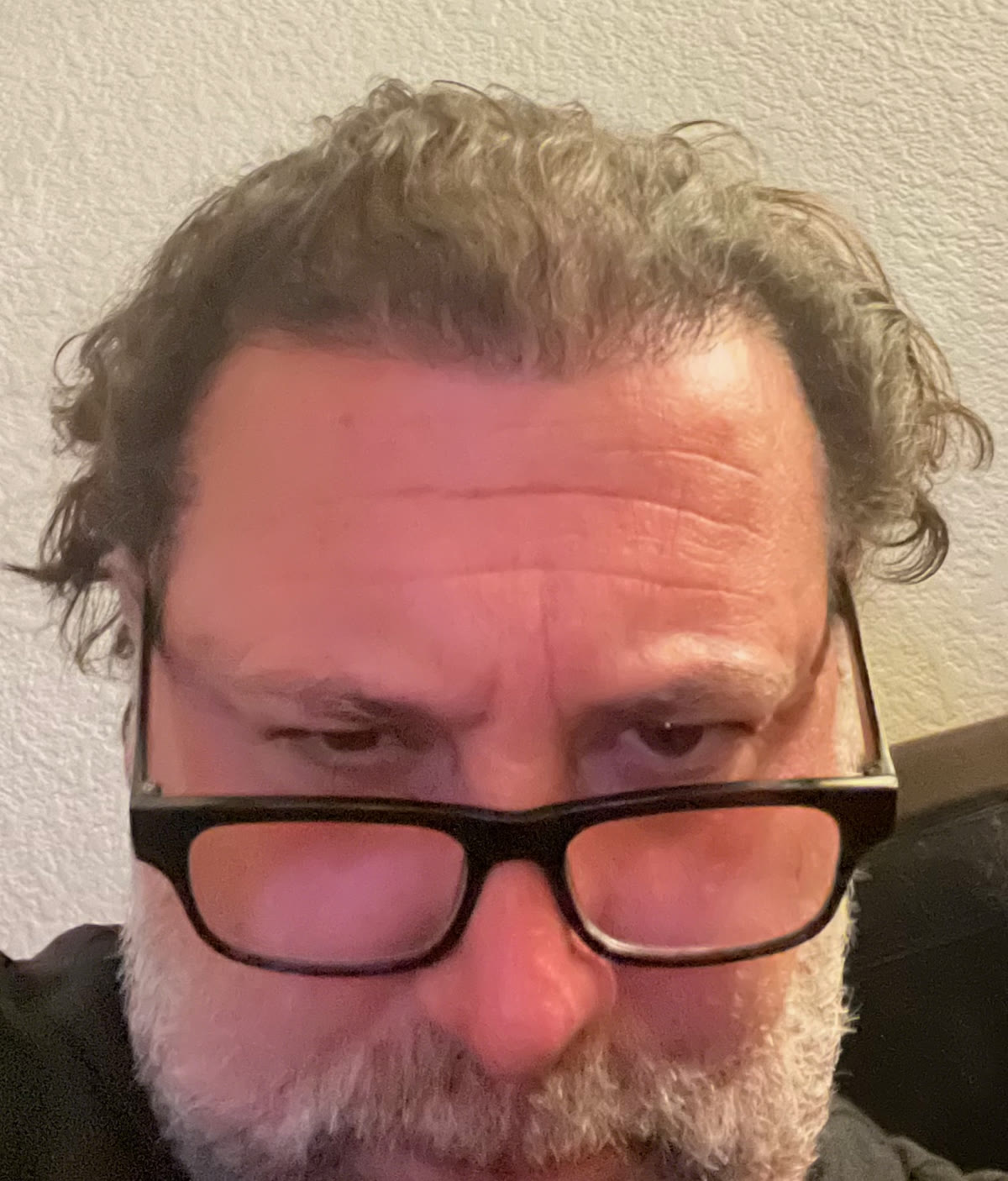 Erik after hair transplant (unedited)