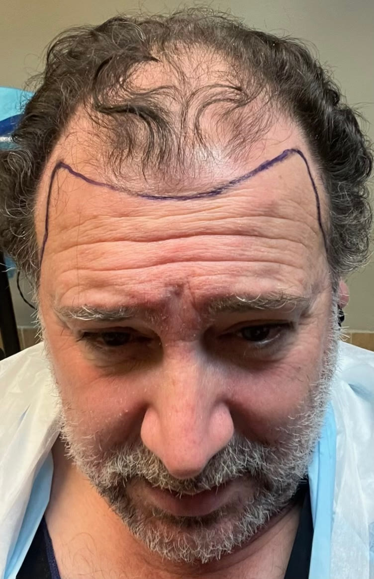 Erik before hair transplant (unedited)