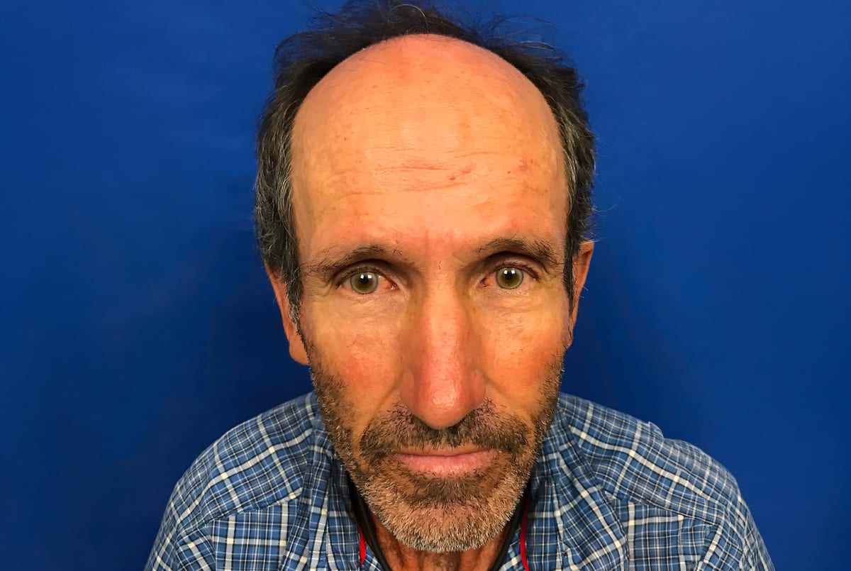 Jeff before hair transplant (unedited)