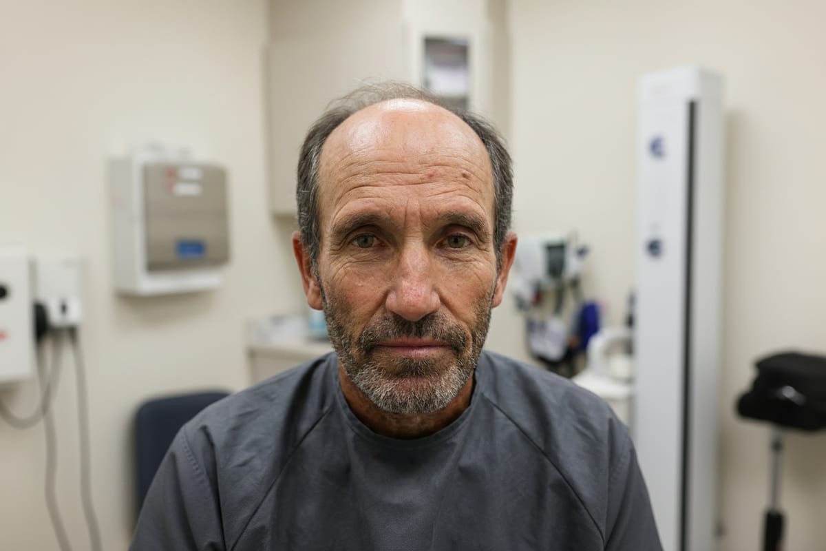 Jeff before hair transplant