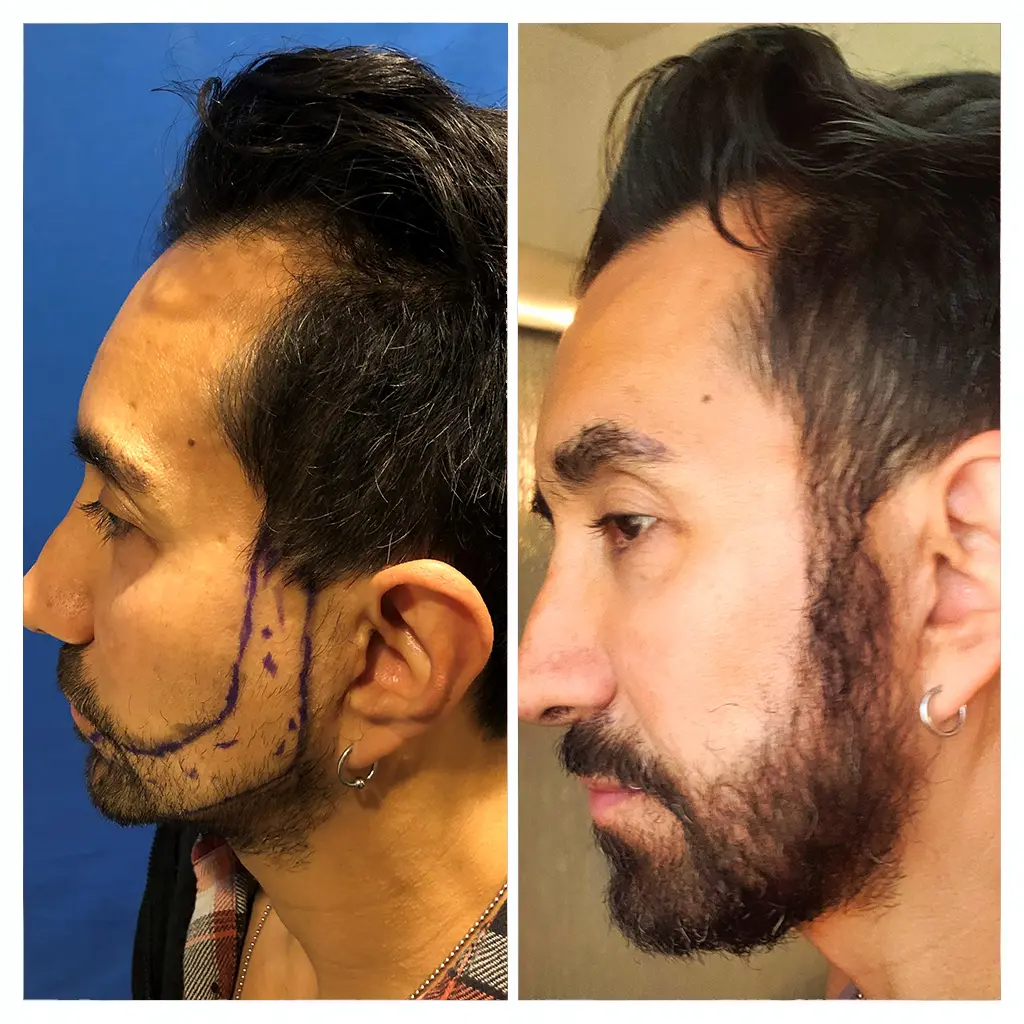 Jorge — before and after beard restoration at Vegas Hair Transplants