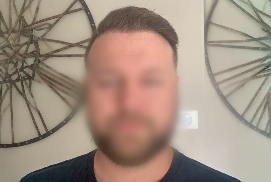JT after hair transplant (unedited)
