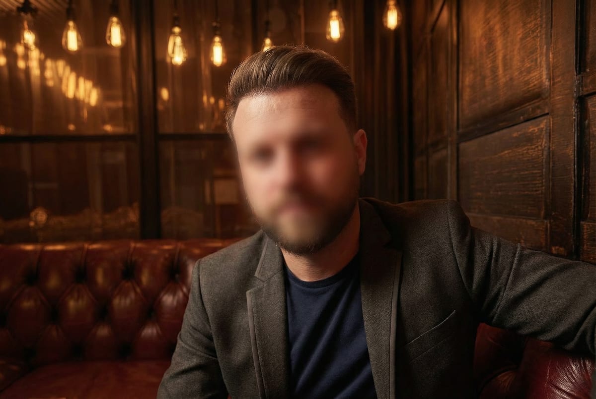 JT after hair transplant