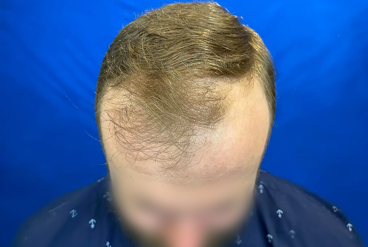 JT before hair transplant (unedited)