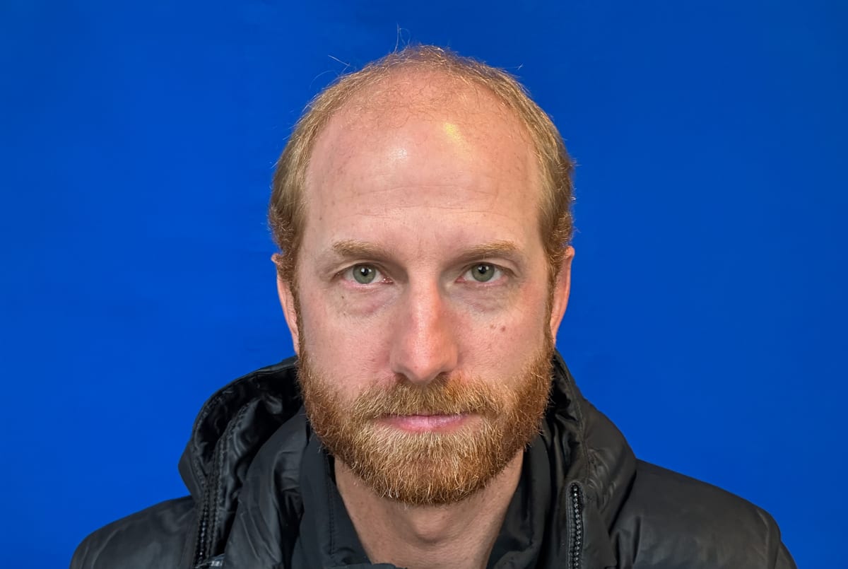 James before hair transplant (unedited)