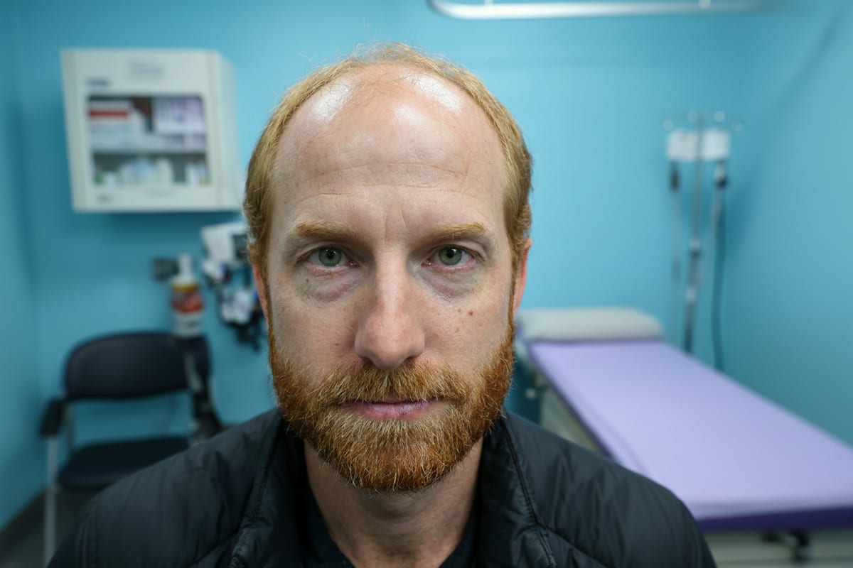 James before hair transplant
