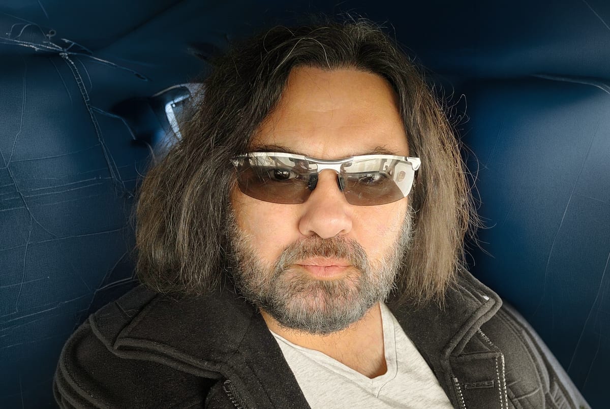 Lott after hair transplant (unedited)