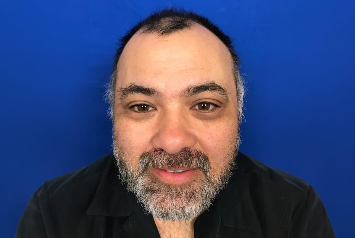 Lott before hair transplant (unedited)