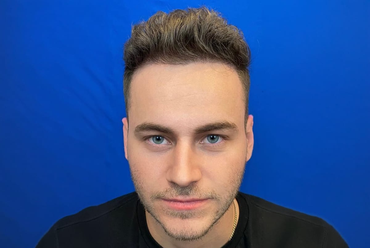 Mason after hair transplant (unedited)