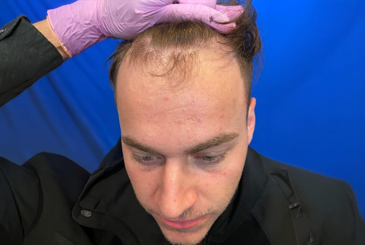 Mason before hair transplant (unedited)