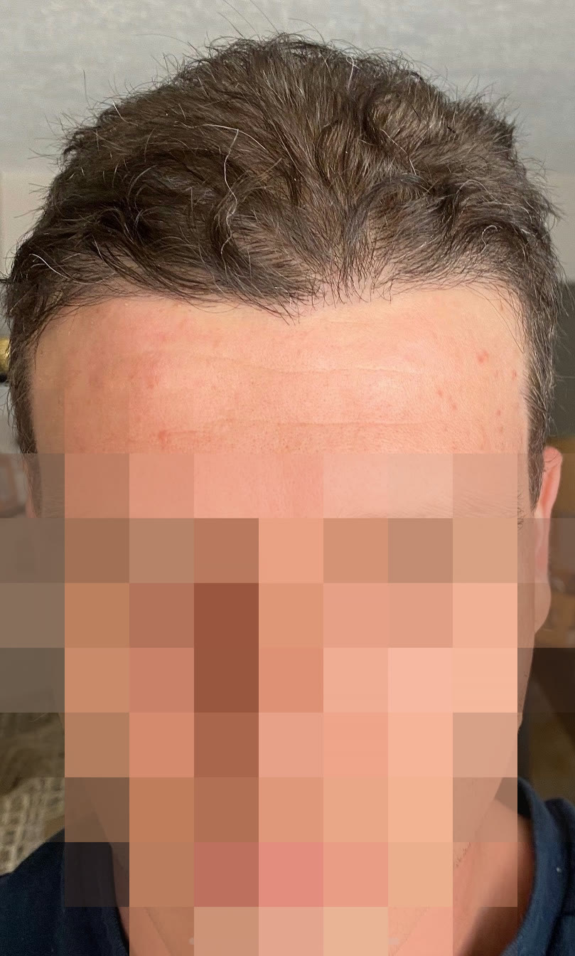 Nick S. after hair transplant (unedited)