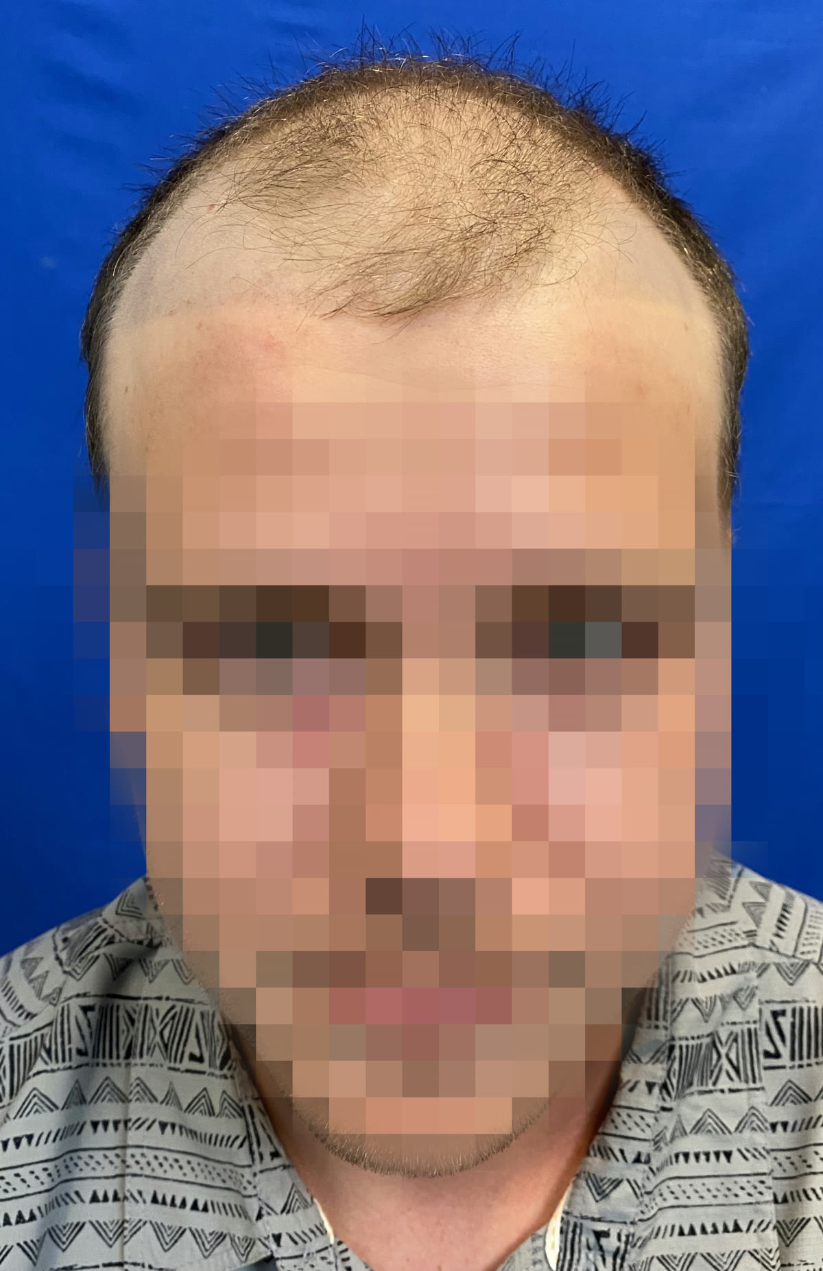 Nick S. before hair transplant (unedited)