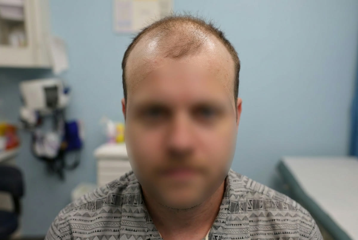 Nick S. before hair transplant