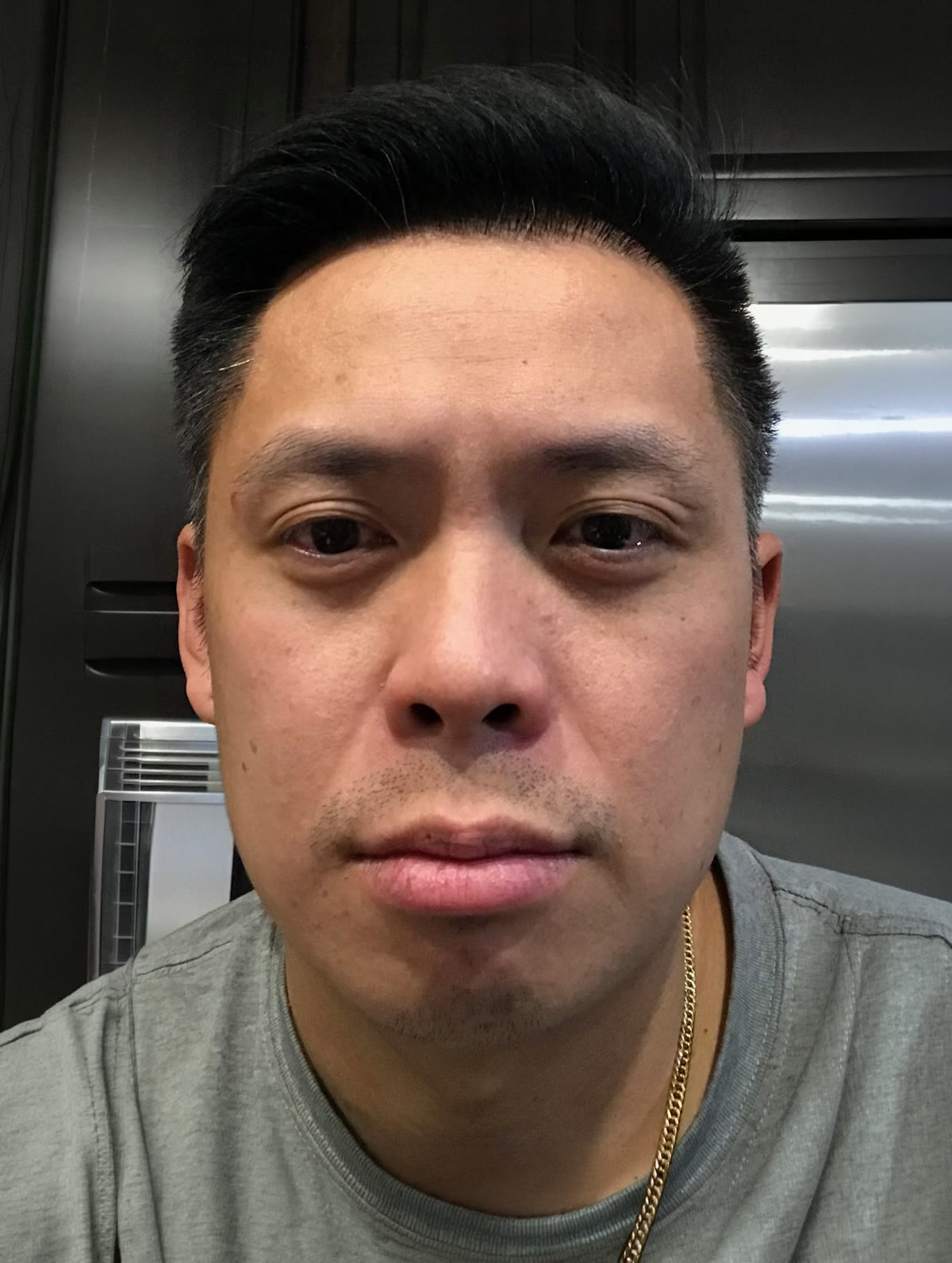 TJ after hair transplant (unedited)