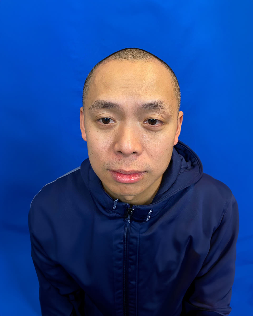 TJ before hair transplant (unedited)
