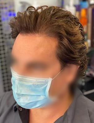 TT after hair transplant (unedited)