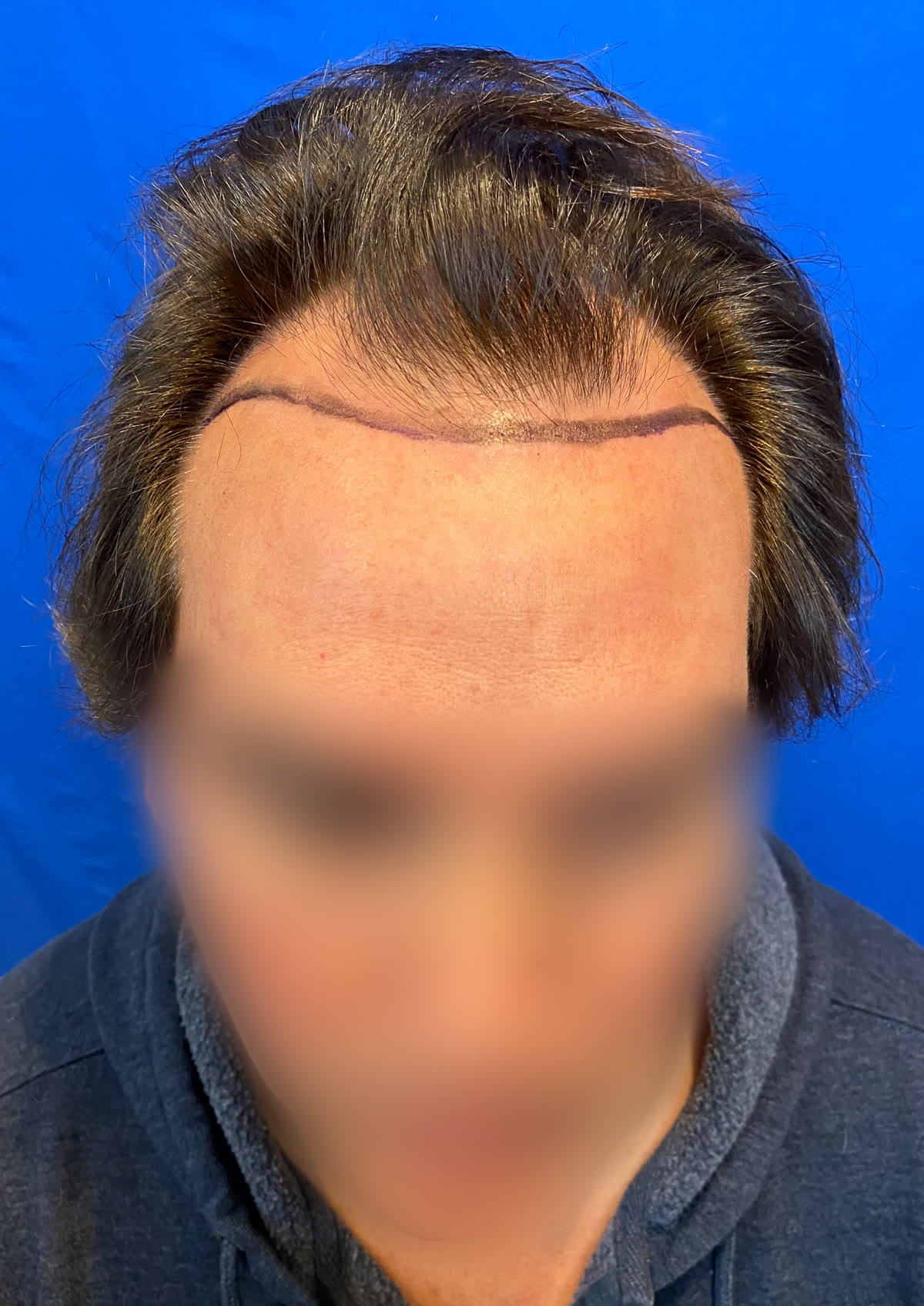 TT before hair transplant (unedited)