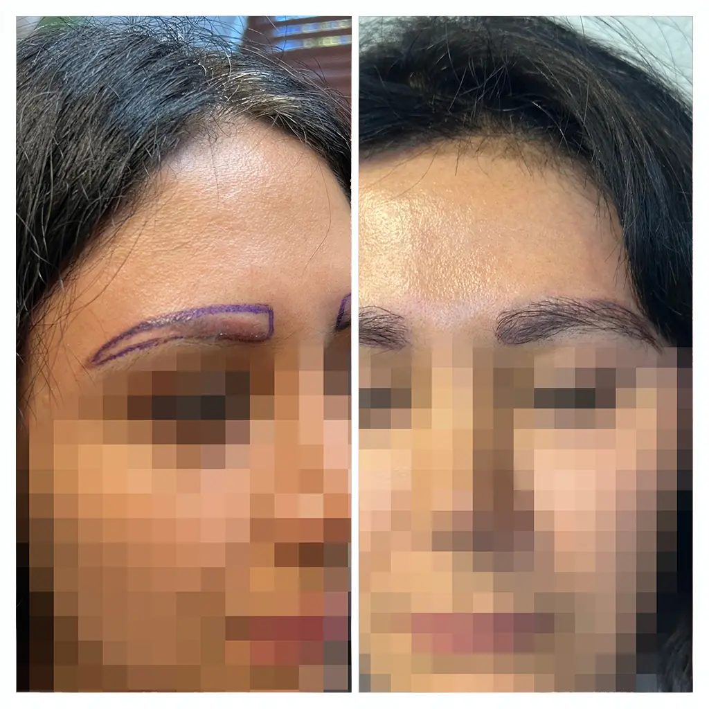 VG — before and after eyebrows restoration at Vegas Hair Transplants